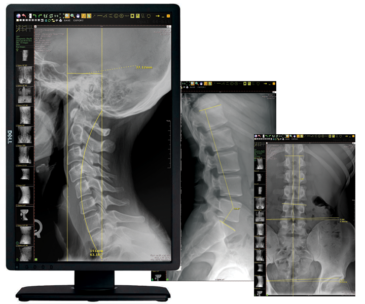 Diagnostic imaging software display showing cervical spine X-ray and lumbar spine measurement overlays